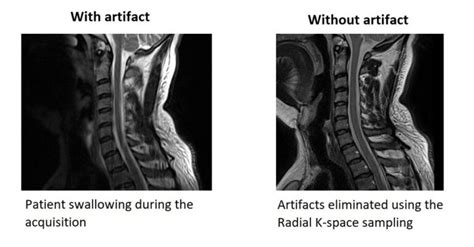 Mri Artifacts Mri Motion Artifact Ghosting Artifact Mri