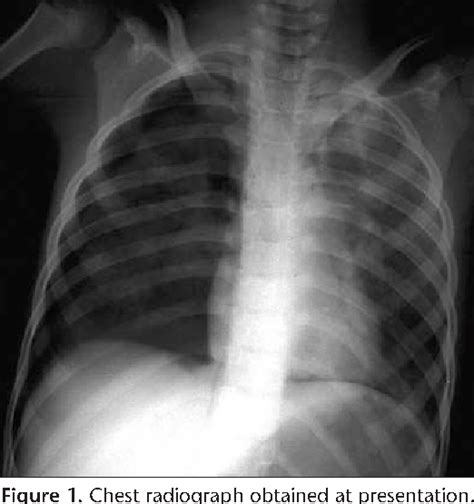 Pdf Fallen Lung Sign Radiographic Findings Semantic Scholar