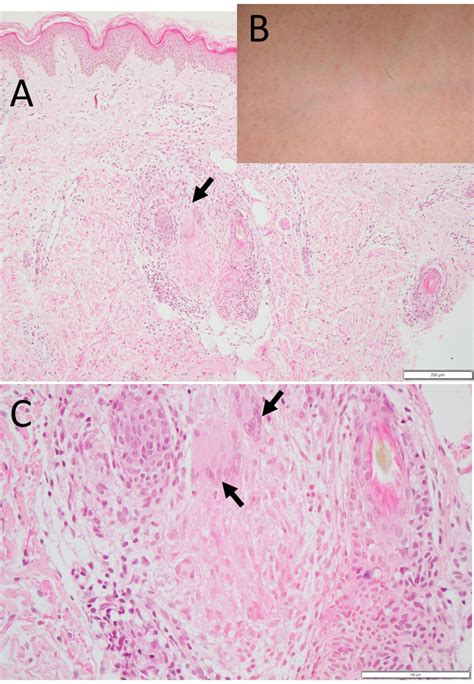 Case 2 Skin Rashes B And Biopsy A C At The Age Of 1 5 Years