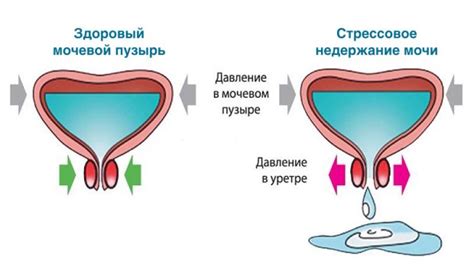 Недержание мочи - признаки, причины, симптомы, лечение и профилактика ...