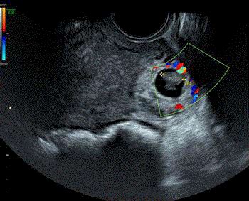 Interstitial Ectopic Pregnancy Diagnosis And Management A Case Report