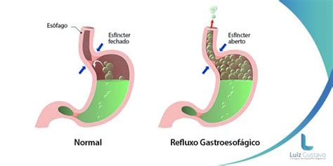 Refluxo gastroesofágico sintomas causas e tratamentos Dr Luiz