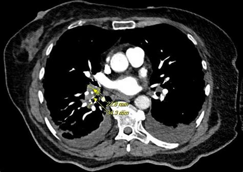 The Patient S Chest Ct Angiography With Contrast Shows Small Pulmonary Download Scientific