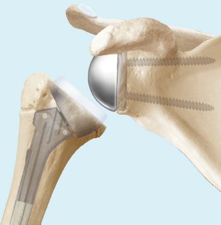 Schulterarthrose Schulterprothese Behandlung Ksw