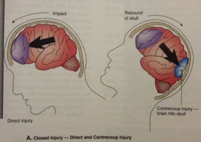 Mechanism of Injury - Traumatic Brain Injury