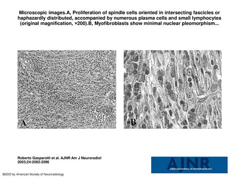 Microscopic Imagesa Proliferation Of Spindle Cells Oriented In