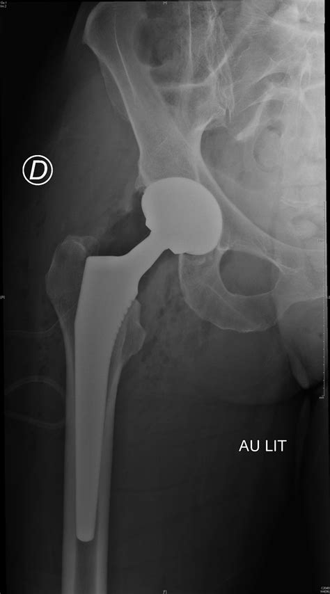 Proth Se Totale De Hanche Intervention Sur La Hanche Ortho