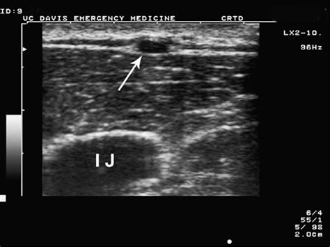 External Jugular Vein Ultrasound