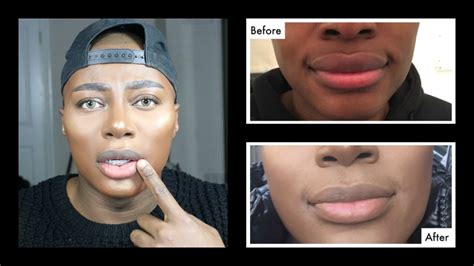 30 How To Dissolve Filler Naturally HamedOlufela