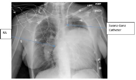 Chest X Ray The Left Cardiac Silhouette Is Severely Enlarged Occupying