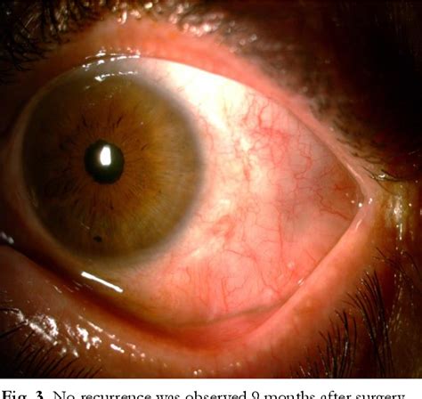 Figure 3 From Conjunctival Lymphangiectasia Case Report Semantic Scholar