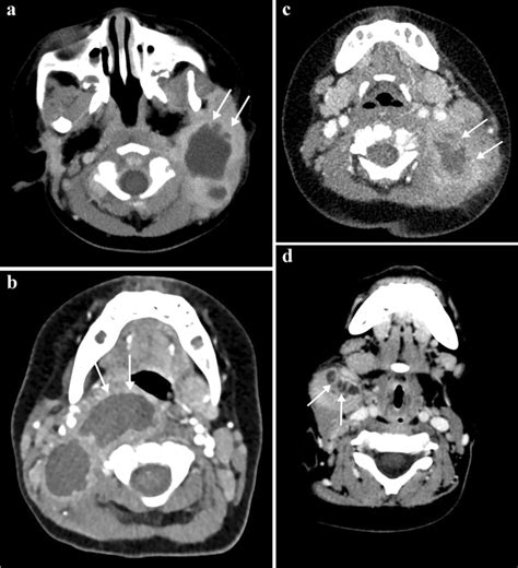 Representative Axial Venous Phase Contrast Enhanced Computed Tomography