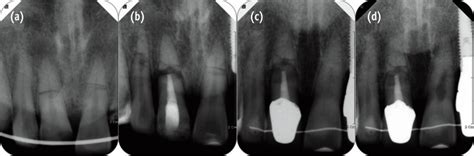 6 Year Follow Up Case Of Horizontal Root Fracture A Horizontal Root Download Scientific