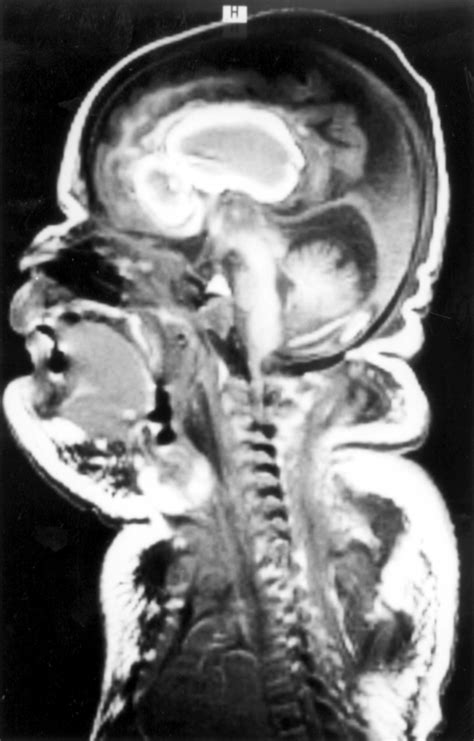 Complex Consanguinity Associated With Short Rib Polydactyly Syndrome