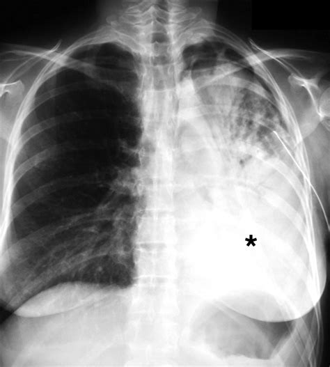 Chest Radiography In Thoracic Polytrauma Ajr