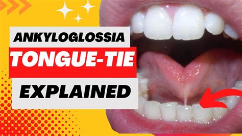 Tongue Tie Ankyloglossia Explained In Minute Youtube