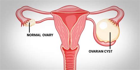 Ovarian Cyst: causes, symptoms, diagnosis and treatment | Dr. Shraddha ...