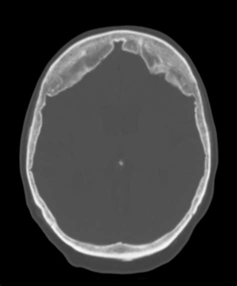 Hyperostosis Frontalis Interna Image