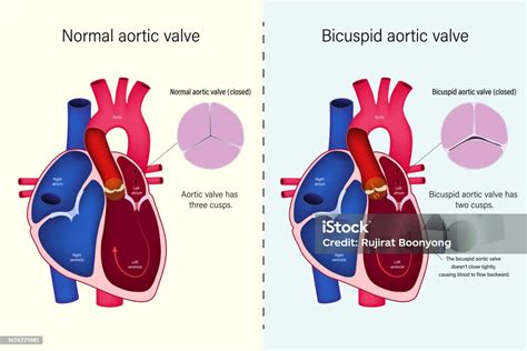 Perbedaan Katup Jantung Normal Dan Vektor Katup Aorta Bicuspid Penyakit ...