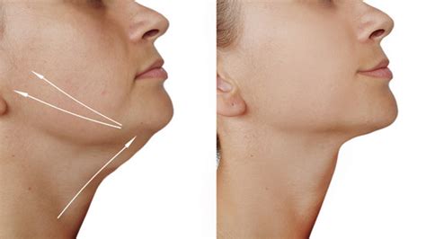 Ajay Rochester W Bikini Na Basenie Uroda