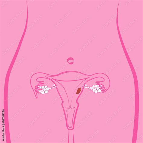 Uterine Fibroid Vector Illustration Vector De Stock Adobe Stock