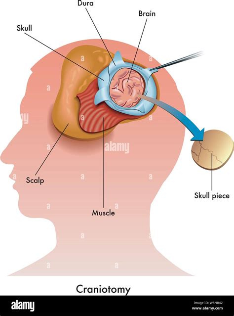 Craniotomy High Resolution Stock Photography and Images - Alamy