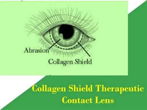 Therapeutic Bandage Contact Lens Uses Types Removal