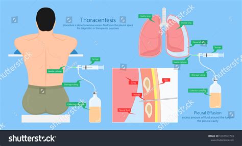 Vats Lung Cancer Treatment Sub Pus Stock Vector Royalty Free 1697553703 Shutterstock