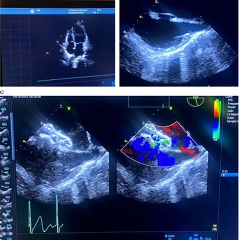 Echocardiography Images After Anticoagulation Treatment And Follow Up