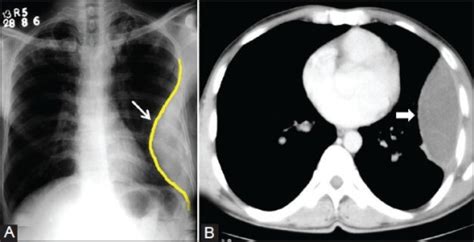 Loculated Empyema A Chest Radiograph Showing Pleural Open I