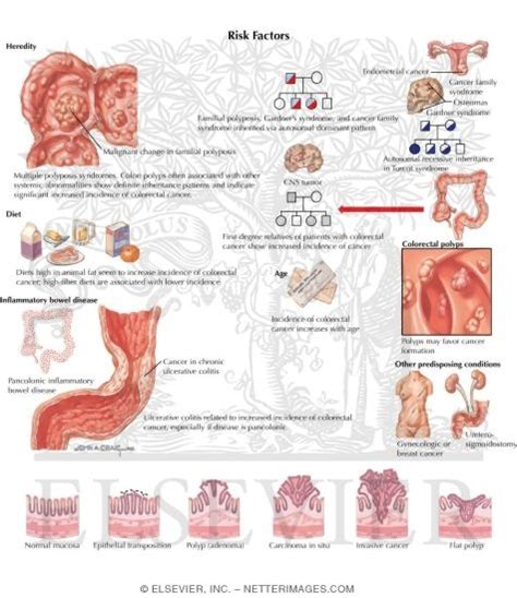 Intestinal Polyps Symptoms