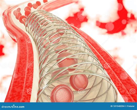 Angioplasty With Stent Placement 3d Rendering Stock Illustration