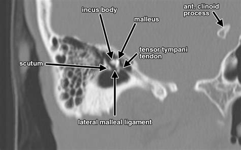 Interactive Web Based Learning Module On Ct Of The Temporal Bone