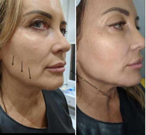 Thread Lifts With Intracel Derma Revive Skin Clinic