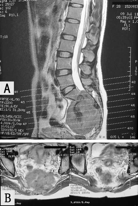 Huge Giant Cell Tumor Of The Sacrum A Case Report