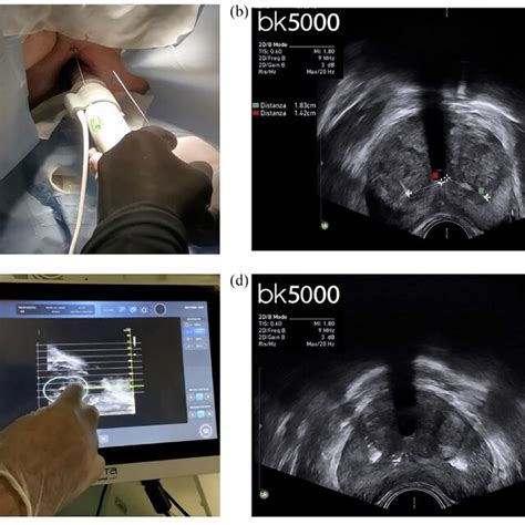 A Insertion Of Needles Using The Transrectal Probe B Measurement Download Scientific