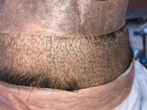 Fue Follicular Unit Extraction Hair Transplant Corrections Dr Brett Bolton