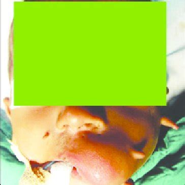 (PDF) Congenital teratoma of the face