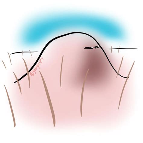 hard sore lump  skin