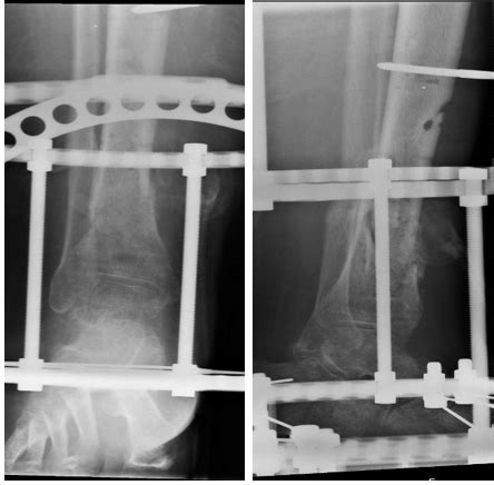 Maintenance Of A Cement Spacer As Definitive Treatment Of Post