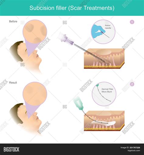 Scar Treatments. Image & Photo (Free Trial) | Bigstock