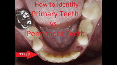 Riverside Dental Surgery Deciduous Teeth What Are Deciduous Off