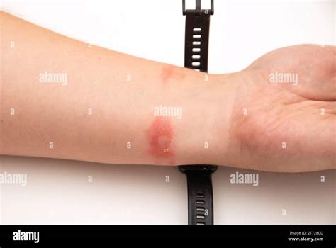 Irritation Redness And Itching On The Skin After Wearing A Watch Or Fitness Bracelet Allergy