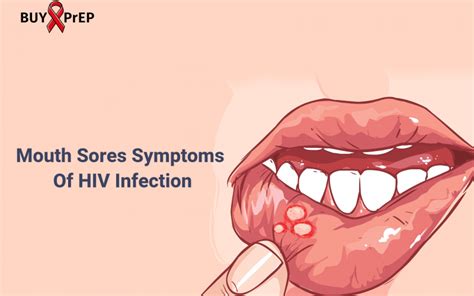 Mouth Sores Symptoms Of HIV Infection - Buy PrEP