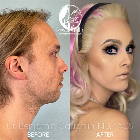 Combination Of Buccal Fat Removal Jawline Sculpting Chin Implant