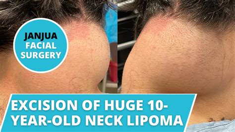 Excision Of Huge 10 Year Old Neck Lipoma Dr Tanveer Janjua New