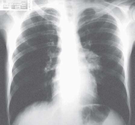 Posterior-anterior chest radiography demonstrating mediastinal lymph ...