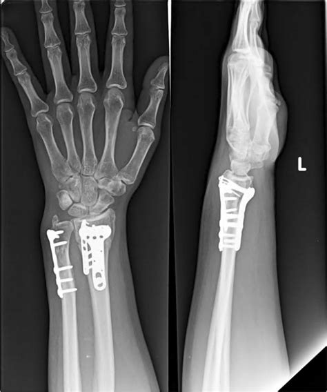 After Plating The Volar Segment Dorsal Ulnar Corner Fixation Was Added