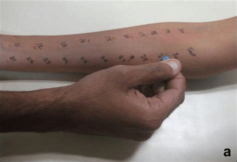 Skin Prick Test A Technique B Wheal And Flare Reactions After