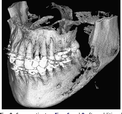 Figure 9 From Alveolar Osteitis And Osteomyelitis Of The Jaws